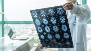 Early Diagnosis Is Crucial for Traumatic Brain Injury